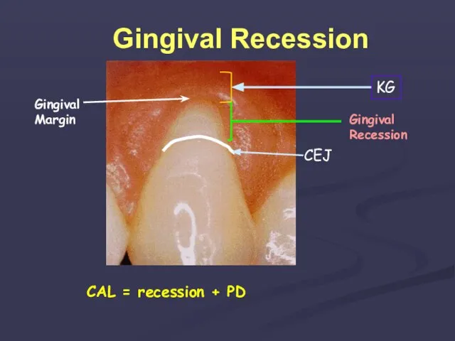 Gingival Recession Gingival Margin Gingival Recession CAL = recession + PD CEJ KG