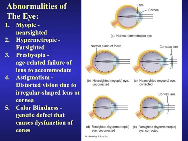 Abnormalities of The Eye: Myopic - nearsighted Hypermetropic - Farsighted Presbyopia -