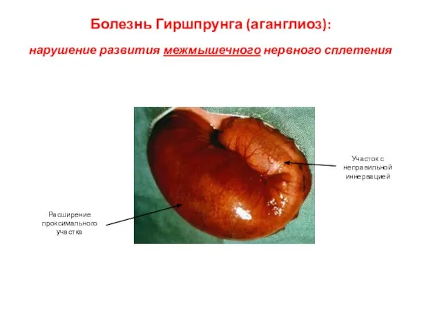 Болезнь Гиршпрунга (аганглиоз): нарушение развития межмышечного нервного сплетения Участок с неправильной иннервацией Расширение проксимального участка