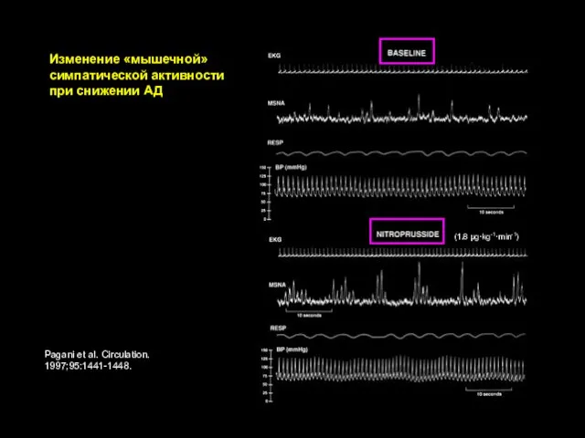 Pagani et al. Circulation. 1997;95:1441-1448. (1.8 µg·kg-1·min-1) Изменение «мышечной» симпатической активности при снижении АД