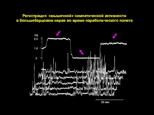 Регистрация «мышечной» симпатической активности в большеберцовом нерве во время параболического полета