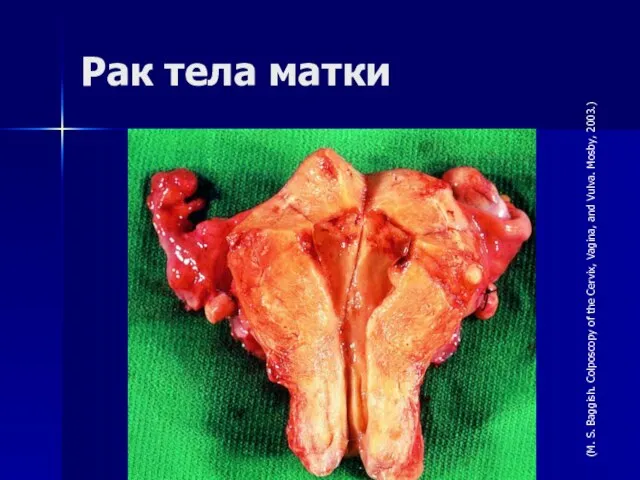 Рак тела матки (M. S. Baggish. Colposcopy of the Cervix, Vagina, and Vulva. Mosby, 2003.)