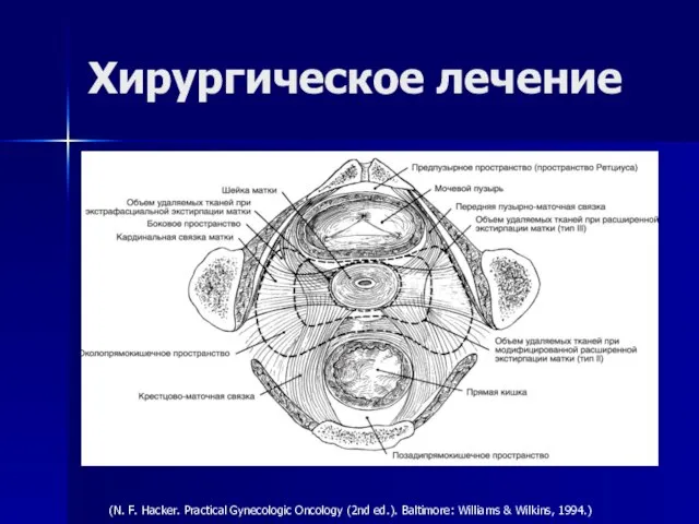 (N. F. Hacker. Practical Gynecologic Oncology (2nd ed.). Baltimore: Williams & Wilkins, 1994.) Хирургическое лечение