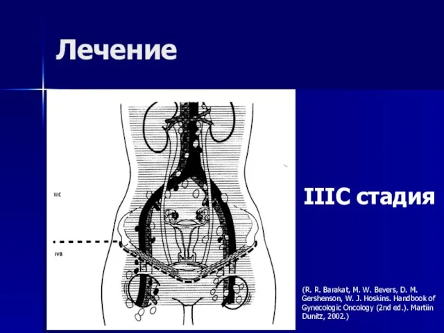 Лечение IIIC стадия (R. R. Barakat, M. W. Bevers, D. M. Gershenson,