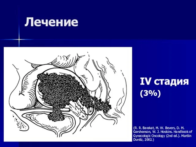 Лечение IV стадия (3%) (R. R. Barakat, M. W. Bevers, D. M.