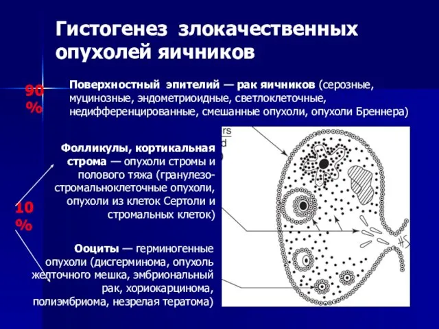 Гистогенез злокачественных опухолей яичников Ооциты — герминогенные опухоли (дисгерминома, опухоль желточного мешка,