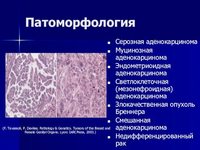 Патоморфология Серозная аденокарцинома Муцинозная аденокарцинома Эндометриоидная аденокарцинома Светлоклеточная (мезонефроидная) аденокарцинома Злокачественная опухоль