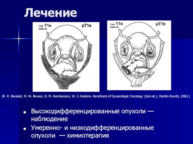 Лечение Высокодифференцированные опухоли — наблюдение Умеренно- и низкодифференцированные опухоли — химиотерапия (R.