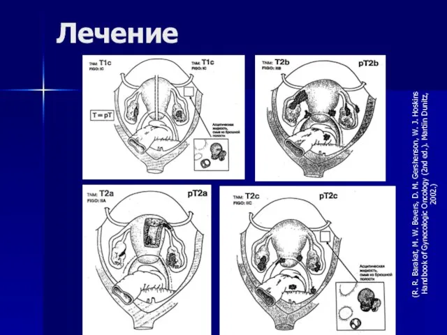 Лечение (R. R. Barakat, M. W. Bevers, D. M. Gershenson, W. J.