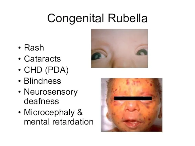 Congenital Rubella Rash Cataracts CHD (PDA) Blindness Neurosensory deafness Microcephaly & mental retardation