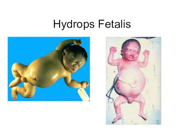 Hydrops Fetalis