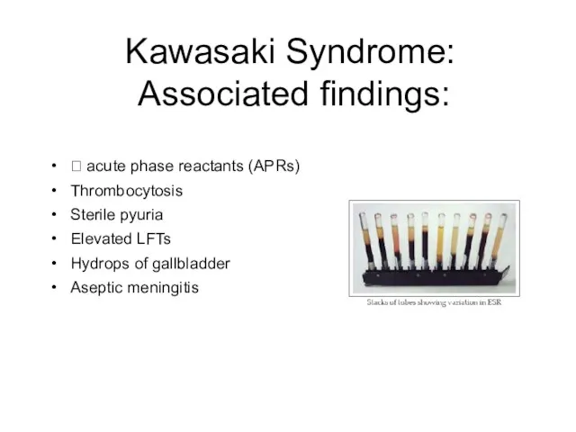 Kawasaki Syndrome: Associated findings: ? acute phase reactants (APRs) Thrombocytosis Sterile pyuria