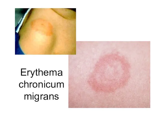 Erythema chronicum migrans
