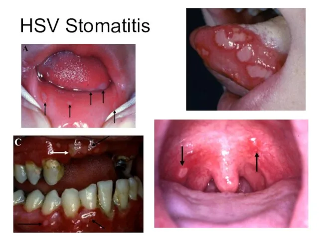 HSV Stomatitis