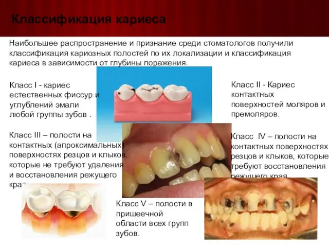 Классификация кариеса Наибольшее распространение и признание среди стоматологов получили классификация кариозных полостей