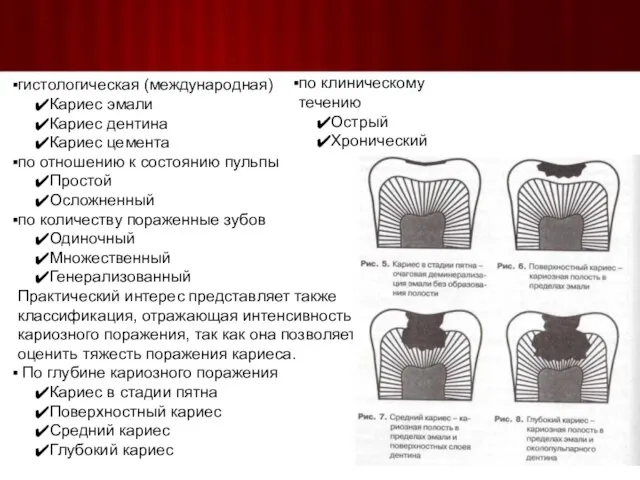 гистологическая (международная) Кариес эмали Кариес дентина Кариес цемента по отношению к состоянию