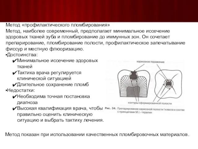 Метод «профилактического пломбирования» Метод, наиболее современный, предполагает минимальное иссечение здоровых тканей зуба