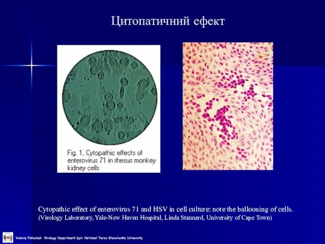 Цитопатичний ефект Cytopathic effect of enterovirus 71 and HSV in cell culture: