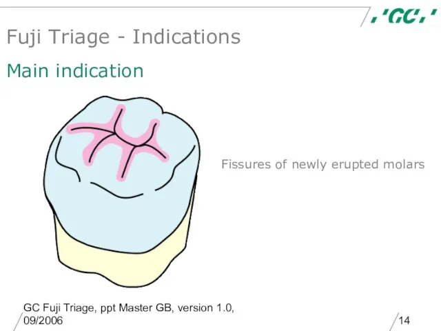 GC Fuji Triage, ppt Master GB, version 1.0, 09/2006 Fissures of newly