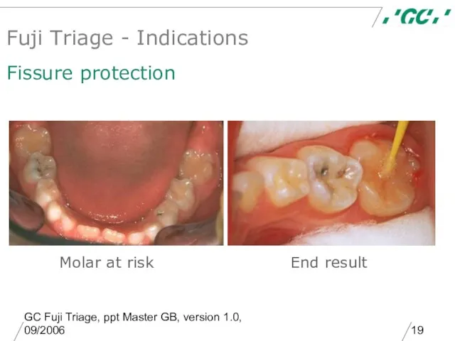 GC Fuji Triage, ppt Master GB, version 1.0, 09/2006 Molar at risk