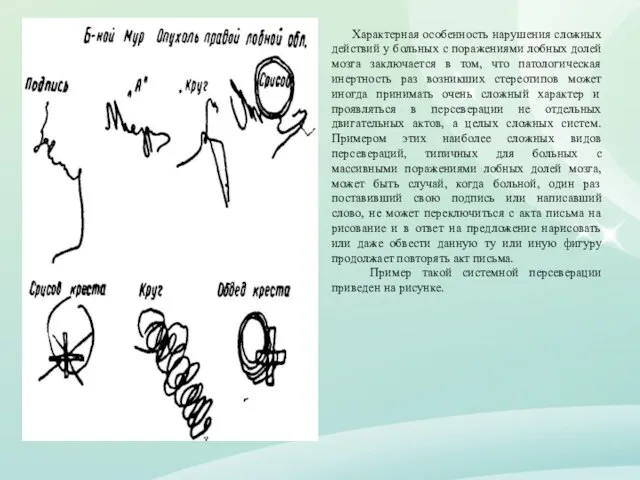 Характерная особенность нарушения сложных действий у больных с поражениями лобных долей мозга