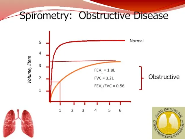 Spirometry: Obstructive Disease Volume, liters Time, seconds 5 4 3 2 1