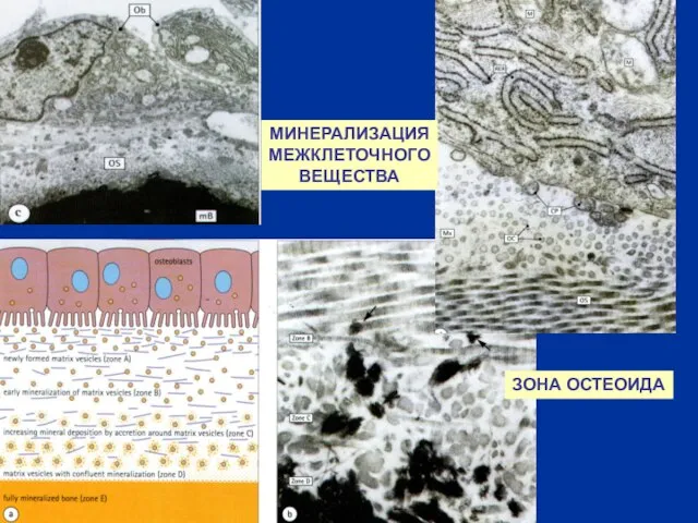 МИНЕРАЛИЗАЦИЯ МЕЖКЛЕТОЧНОГО ВЕЩЕСТВА ЗОНА ОСТЕОИДА