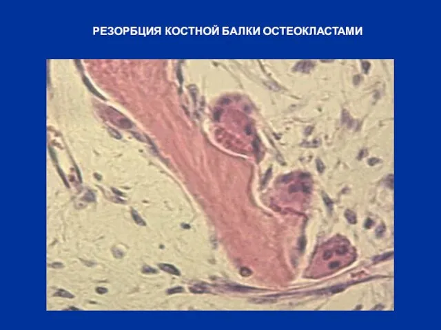 РЕЗОРБЦИЯ КОСТНОЙ БАЛКИ ОСТЕОКЛАСТАМИ