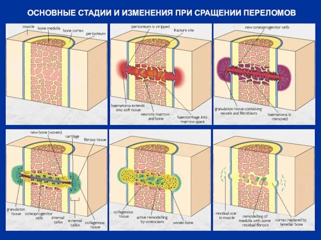 ОСНОВНЫЕ СТАДИИ И ИЗМЕНЕНИЯ ПРИ СРАЩЕНИИ ПЕРЕЛОМОВ