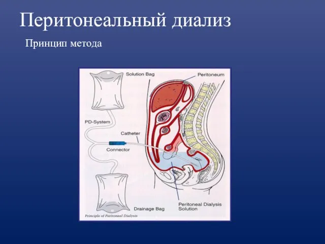 Перитонеальный диализ Принцип метода