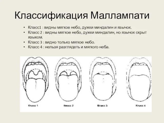 Классификация Маллампати Класс1 : видны мягкое небо, дужки миндалин и язычок. Класс