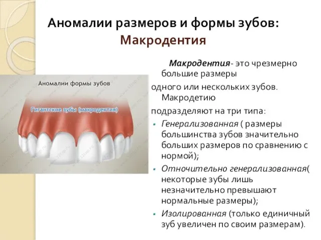 Аномалии размеров и формы зубов: Макродентия Макродентия- это чрезмерно большие размеры одного