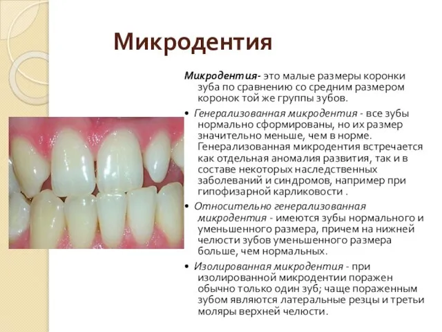 Микродентия Микродентия- это малые размеры коронки зуба по сравнению со средним размером