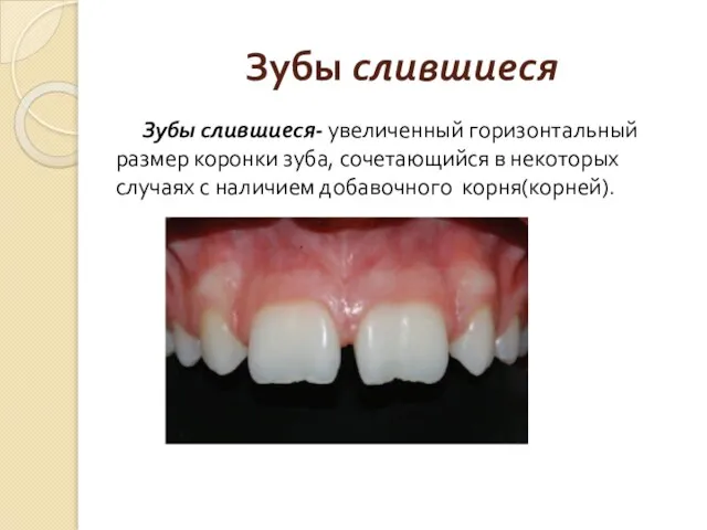 Зубы слившиеся Зубы слившиеся- увеличенный горизонтальный размер коронки зуба, сочетающийся в некоторых