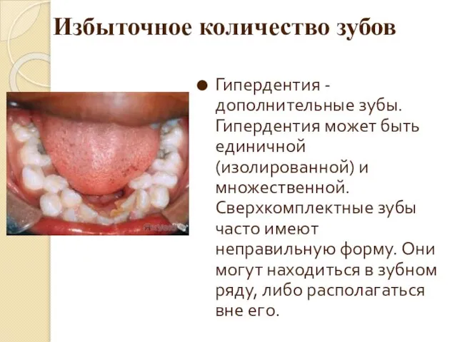 Избыточное количество зубов Гипердентия - дополнительные зубы. Гипердентия может быть единичной (изолированной)
