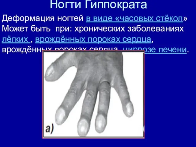 Ногти Гиппократа Деформация ногтей в виде «часовых стёкол» Может быть при: хронических