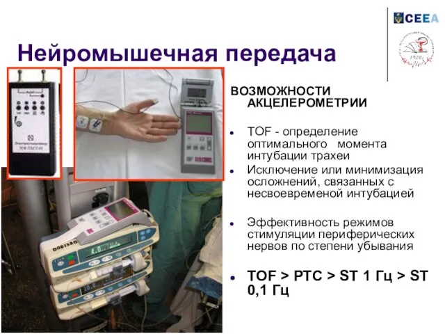 Нейромышечная передача ВОЗМОЖНОСТИ АКЦЕЛЕРОМЕТРИИ TOF - определение оптимального момента интубации трахеи Исключение