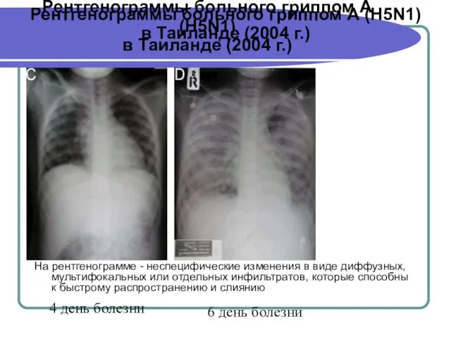 Рентгенограммы больного гриппом А (H5N1) в Таиланде (2004 г.) 4 день болезни