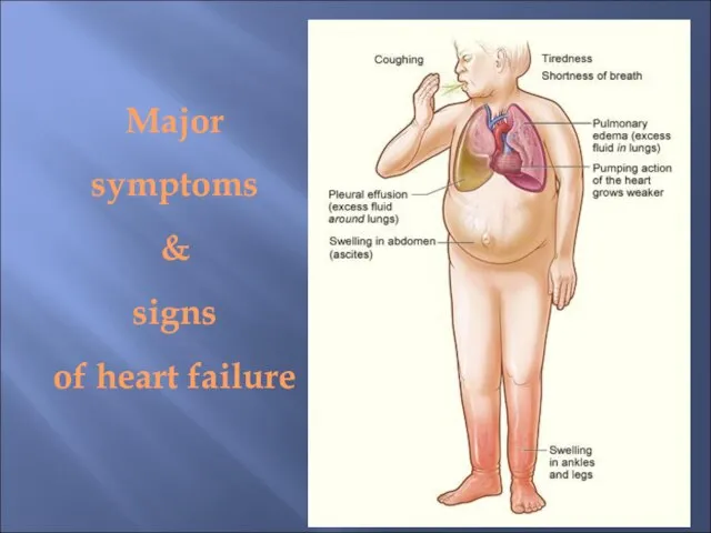 Major symptoms & signs of heart failure