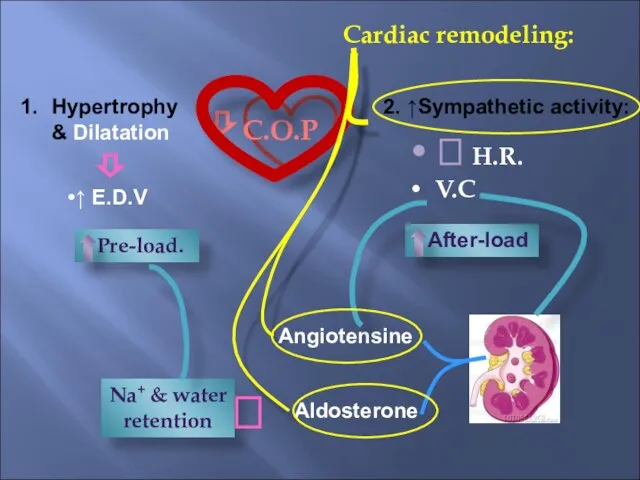 ⇩ C.O.P Cardiac remodeling: Hypertrophy & Dilatation ↑ E.D.V ⇩ 2. ↑Sympathetic