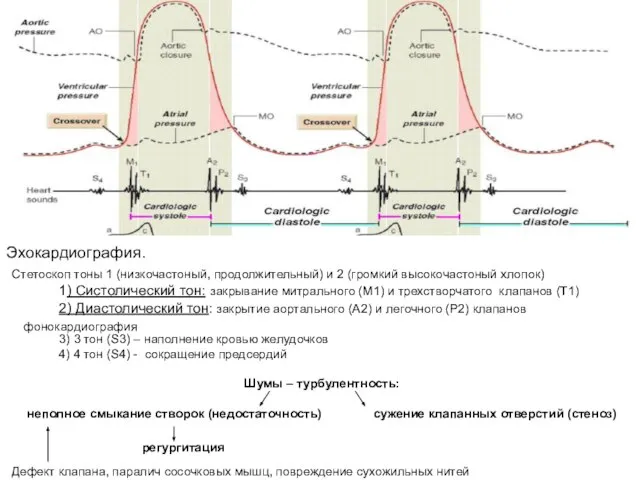 Эхокардиография. 1) Систолический тон: закрывание митрального (M1) и трехстворчатого клапанов (T1) 2)