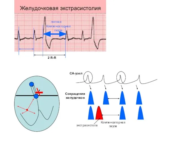 СА-узел Сокращения желудочков экстрасистола Компенсаторная пауза Компенсаторная пауза полная 2 R-R