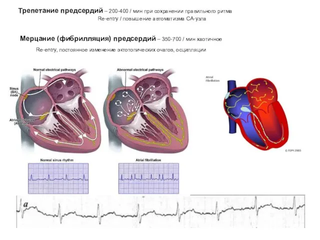 Трепетание предсердий – 200-400 / мин при сохранении правильного ритма Re-entry /