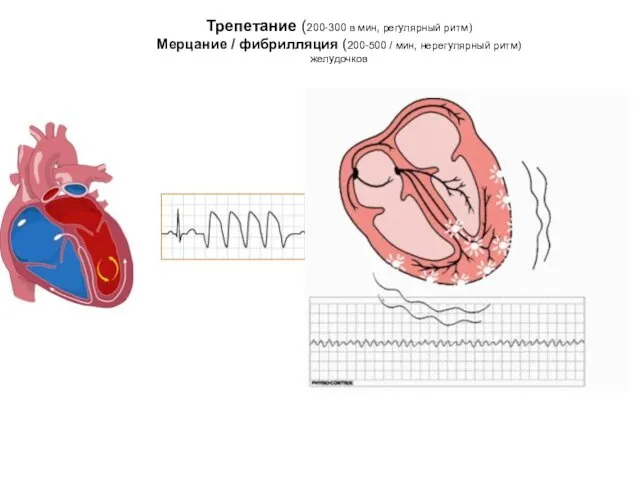 Трепетание (200-300 в мин, регулярный ритм) Мерцание / фибрилляция (200-500 / мин, нерегулярный ритм) желудочков