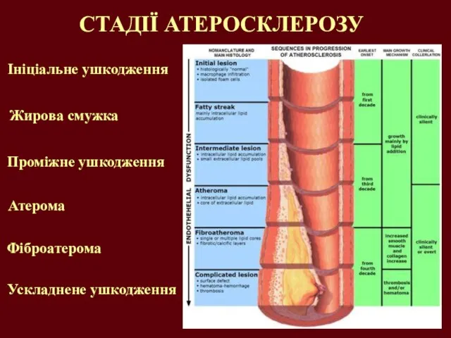 СТАДІЇ АТЕРОСКЛЕРОЗУ Ініціальне ушкодження Жирова смужка Проміжне ушкодження Атерома Фіброатерома Ускладнене ушкодження