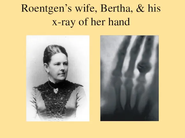 Roentgen’s wife, Bertha, & his x-ray of her hand