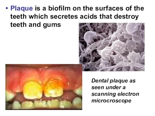 Plaque is a biofilm on the surfaces of the teeth which secretes