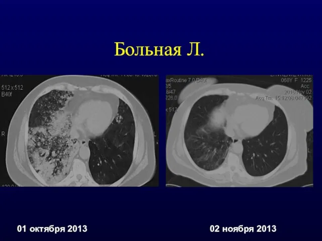 Больная Л. 01 октября 2013 02 ноября 2013