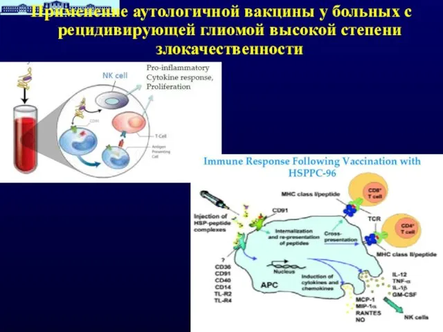 Применение аутологичной вакцины у больных с рецидивирующей глиомой высокой степени злокачественности