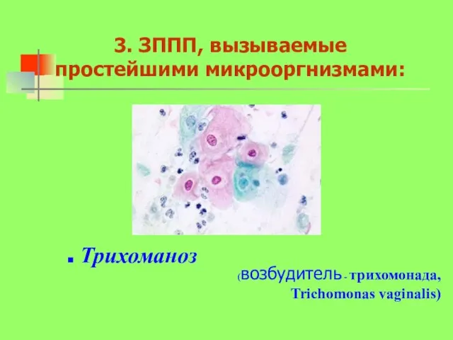 3. ЗППП, вызываемые простейшими микрооргнизмами: Трихоманоз (возбудитель - трихомонада, Trichomonas vaginalis)